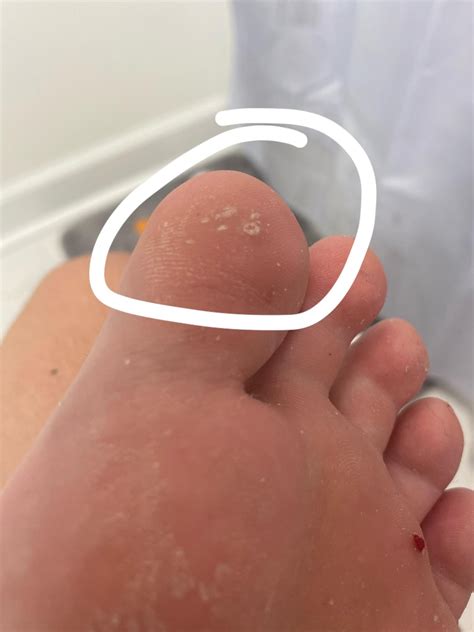 are these forming warts? or calluses? : r/Warts
