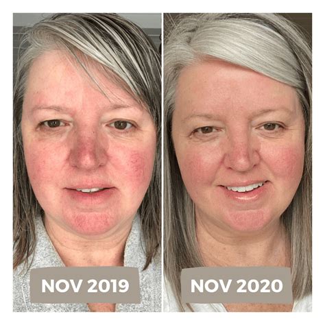 My Experience with Laser Treatment for Rosacea including Before & After Photos - dimplesonmywhat