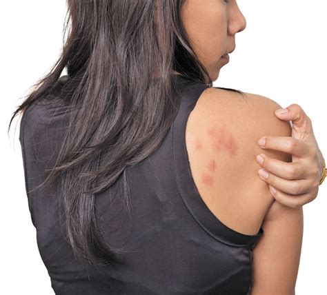 Allergy Hives Go Away at Scott Paramore blog