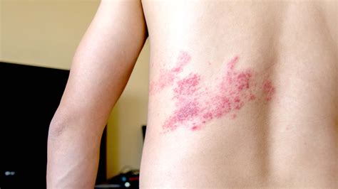Different Stages Of Shingles What To Expect With Shingles Rash: Early