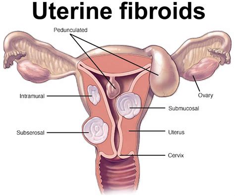 Myoma, fibroids, fibroids in womb, causes, symptoms, diagnosis, treatment & prognosis