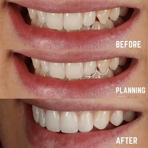 Composite Resin Bonding | Helix Dental Mermaid Water