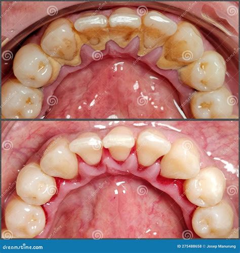 Before and after Cleaning Plaque and Tartar on Human Teeth Stock Photo - Image of dental ...
