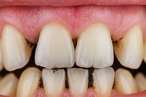 Black Tartar On Teeth