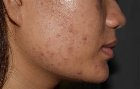 Post-Inflammatory Hyperpigmentation Caused By Acne | Sozo Clinic