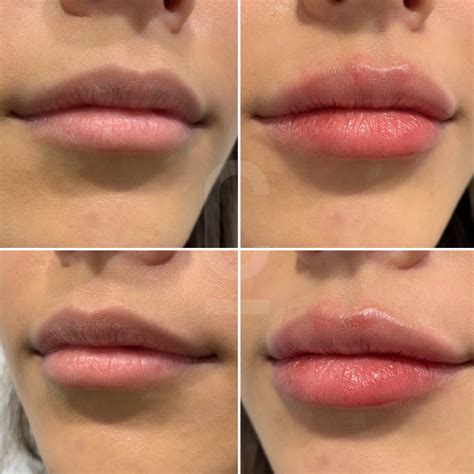 Lip Filler Granuloma at Janice Bottorff blog