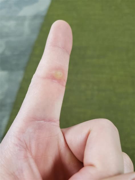 Bump on index finger : r/DiagnoseMe