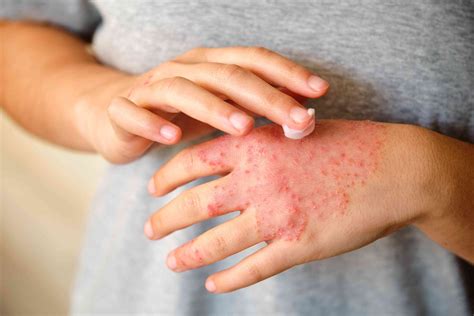 Hives vs. Eczema: What's the Difference?