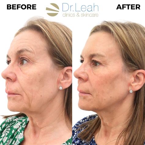 Tackle facial sagging with thread lifts - The Tweakments Guide