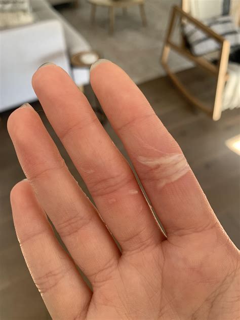 Mild rope burn : r/DermatologyQuestions
