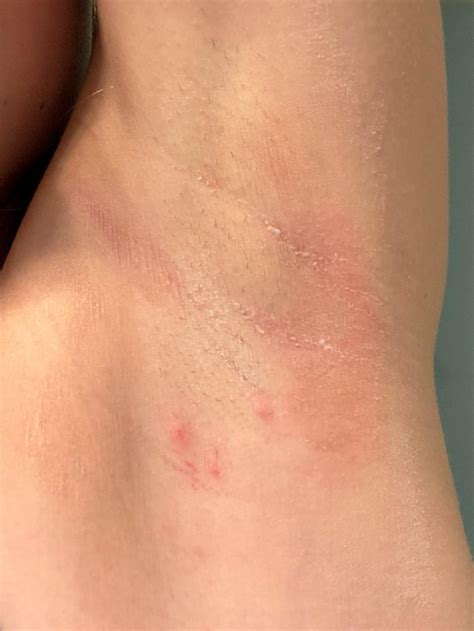 Baking Soda Armpit Rash