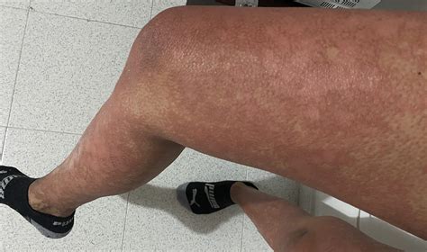 Successful combination treatment for pityriasis rubra pilaris ...