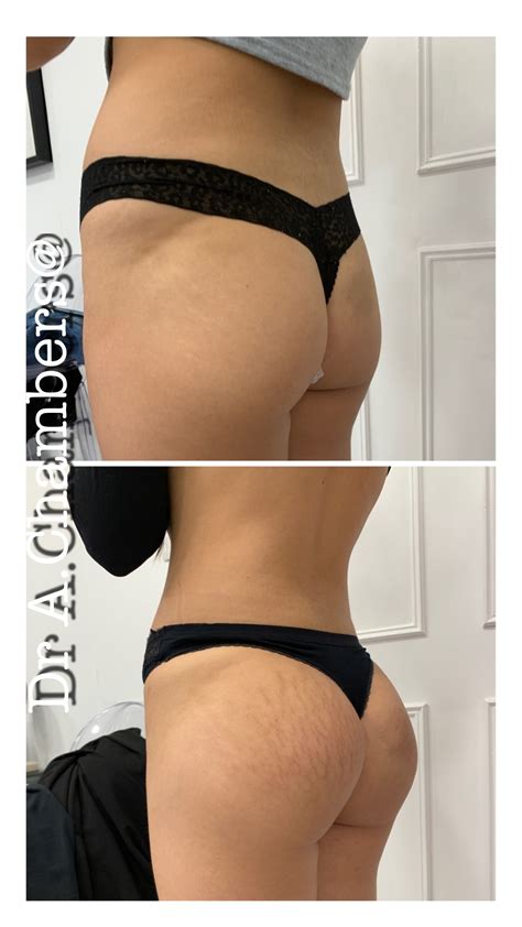 Buttock lift - Dr Alex Chambers | Medical Aesthetic Practice