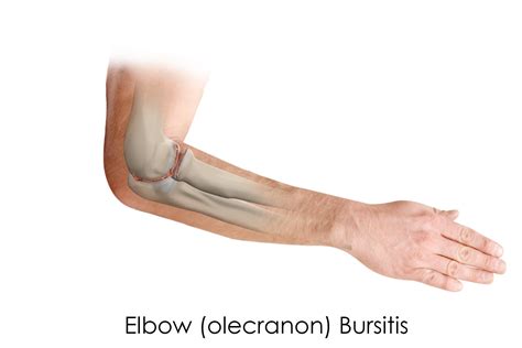 Elbow Protection Bursitis at David Montelongo blog