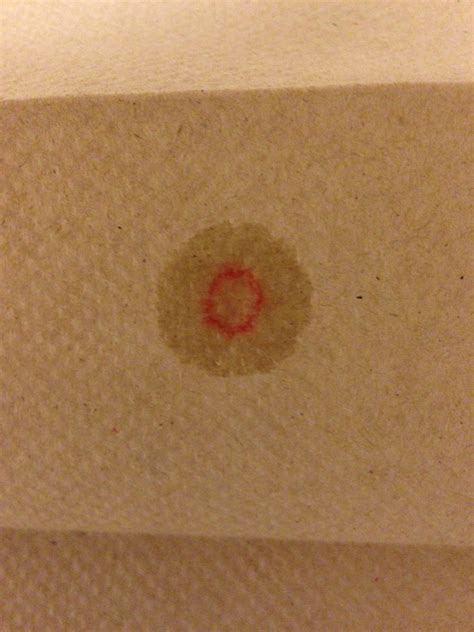 Le Fort Fractures | Treatment & Management | Point of Care