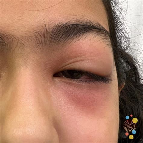 Periorbital Cellulitis Orbital And Preseptal Cellulitis | Concise