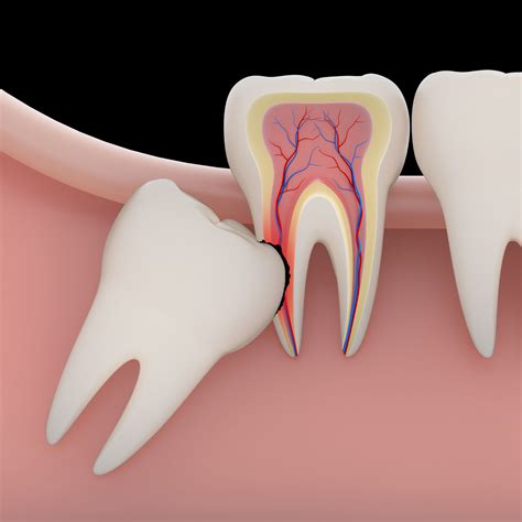 Emergency Wisdom Tooth Removal - Philadelphia, PA - Bucks County - Doylestown, PA