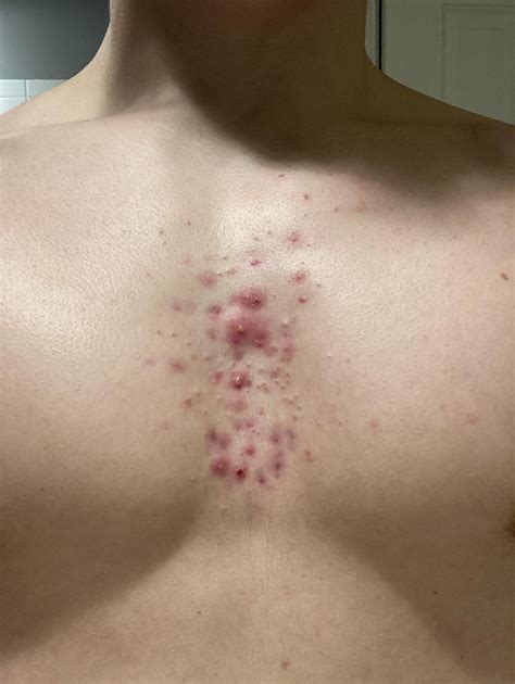 I have really annoying chest acne. What should I do? : r/acne