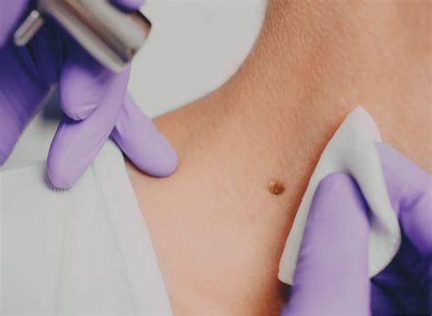 Red spots | angioma removal | Cherry angiomas treatment | rtwskin