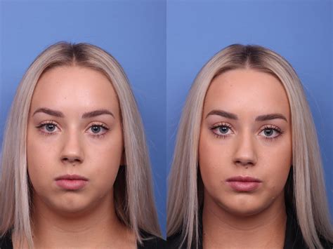 Chin Implant Before and After Photo Gallery | Scottsdale, AZ | Hobgood Facial Plastic Surgery ...