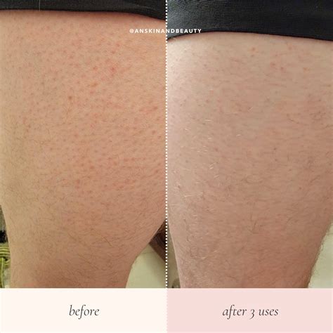 Keratosis Pilaris Legs