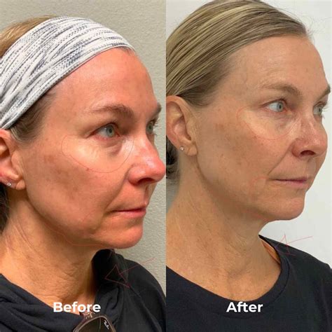 RF Microneedling Before & After Results