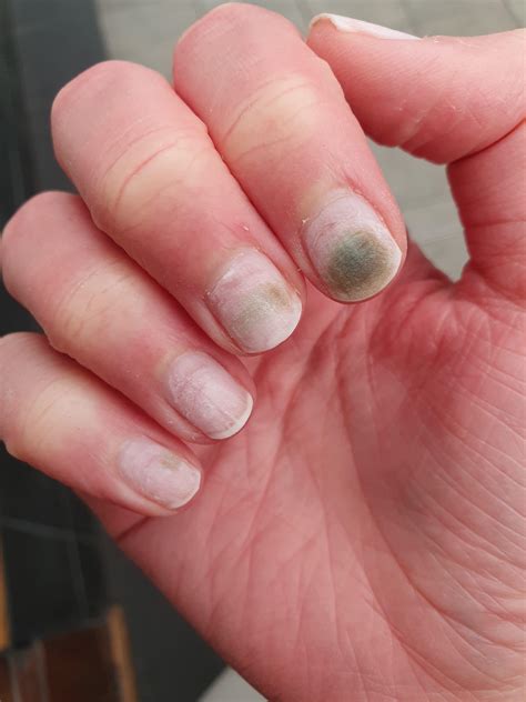 Acrylic Nail Fungus Symptoms