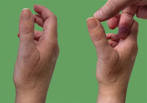 Ulnar collateral ligament (UCL) injury of thumb - Fife Virtual Hand Clinic