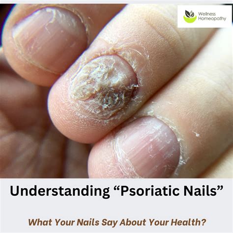 Understanding Psoriatic Nails: A Holistic Approach for Relief | Wellness Homeopathy NZ ...