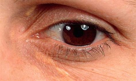 Xanthelasma Nhs XANTHELASMA (or XANTHELASMA PALPEBRA)