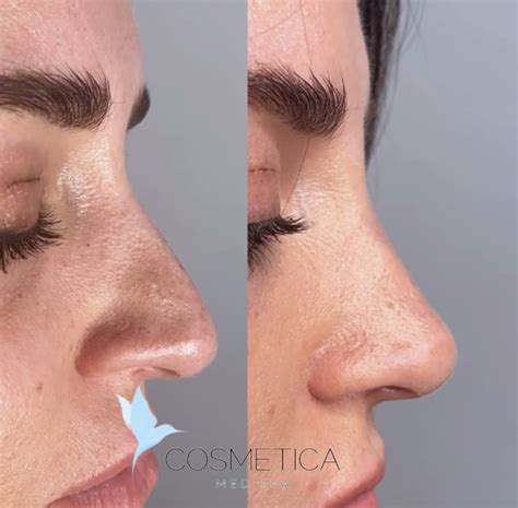 Non-Surgical Nose Job in Boca Raton, FL | Cosmetica Med Spa