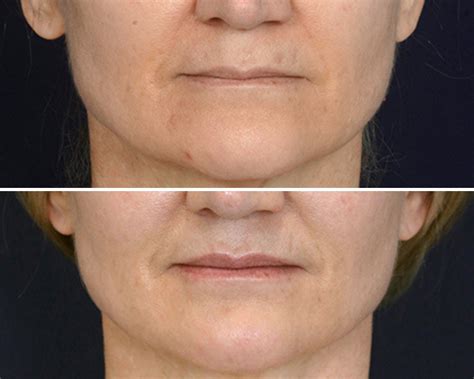 Facial Fat Grafting Vermont | Vermont Plastic Surgery | Natural Facial Volume Restoration