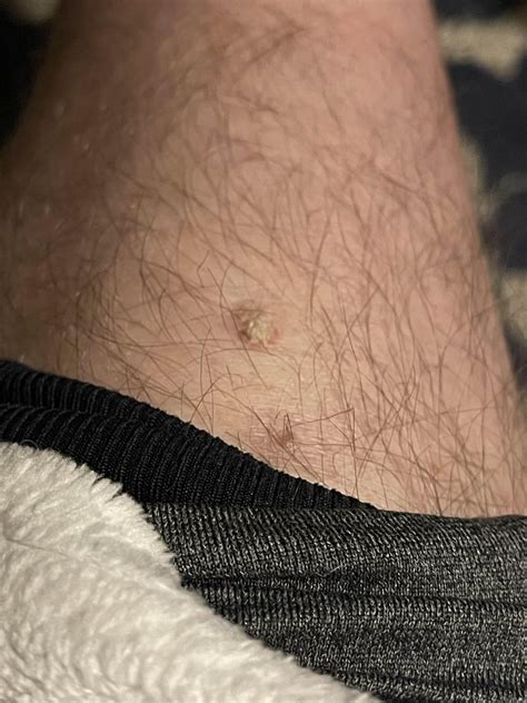 Finally got my crusty mole tested : r/Melanoma