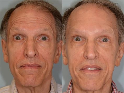 Endoscopic Brow lift