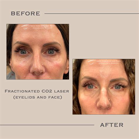 AcuPulse CO2 Laser - West Harrison, NY: New York Eye and Face Oculoplastic Surgery