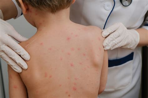 Chicken Pox Rash
