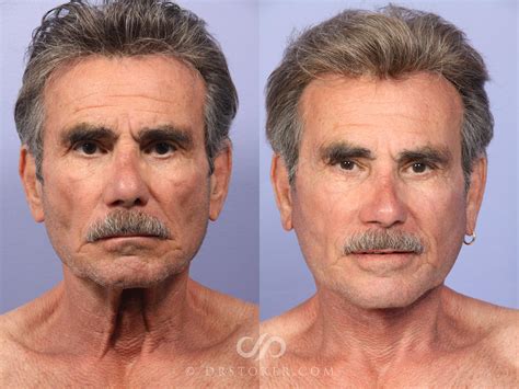 Embracing Change: Plastic Surgery for Men – Dr. David Stoker