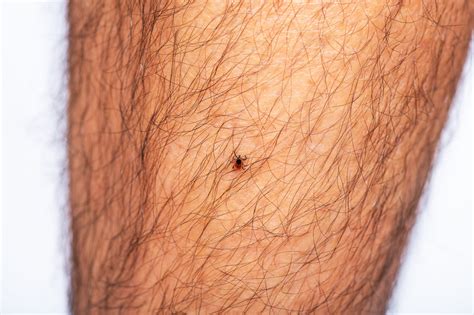 Tick Bite After Removal