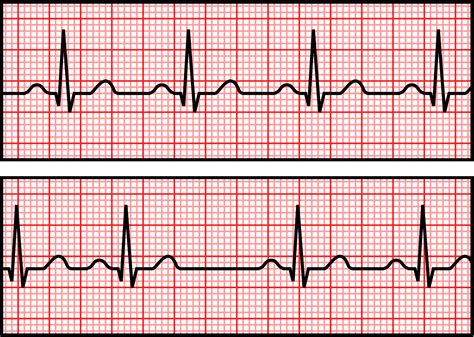Ventricular Fibrillation Rhythm Strip