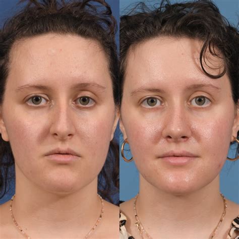 Septoplasty Before & After #20