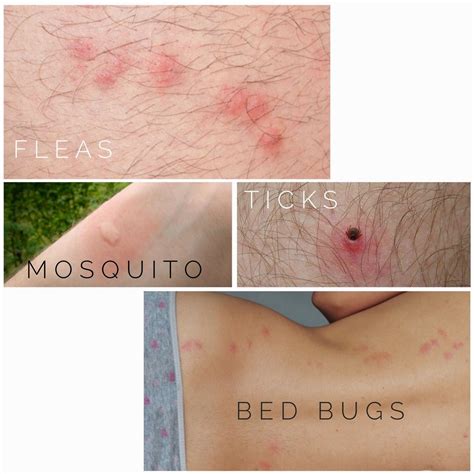 Mosquito vs Flea Bites: Spot the Difference!