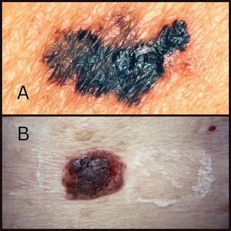 Seborrheic Keratosis: Causes, Signs & Care