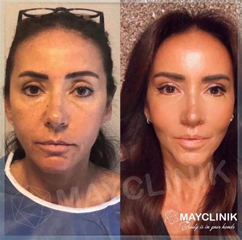 Endoscopic Mid Face Lift Turkey & Cost 2026 | MAYCLINIK