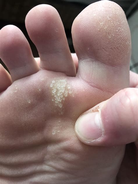 Why Are There Yellow Spots On My Feet at Malik Keck blog