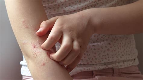 Is Eczema an Autoimmune Disease? Causes, Symptoms, and Treatment - GoodRx