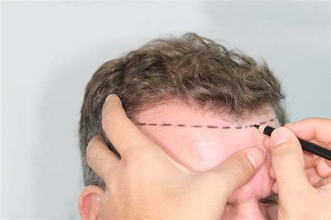Different Types of Hairlines and How to Identify Yours