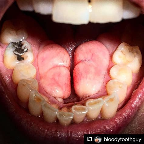 Dental tori: bony growths inside the mouth | Teeth talk | Dental humor, Dental surgery, Dental life