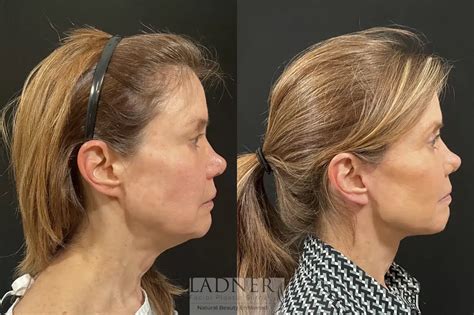 Deep Plane Facelift / Neck Lift - Ladner Facial Plastic Surgery