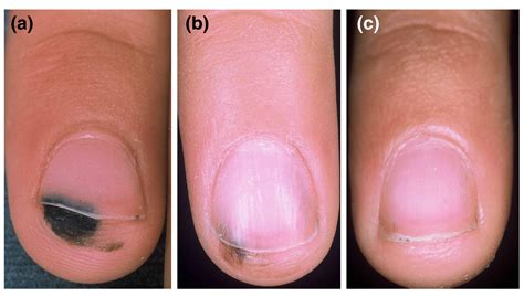 Normal Black Line On Toenail Vs Melanoma at Allyson Byerly blog