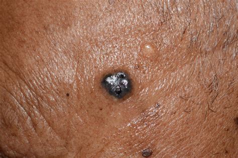 Skin Cancer On Face Pictures